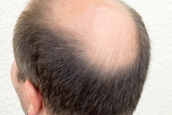 كيف يؤثر التستوستيرون على تساقط الشعر عند الرجال