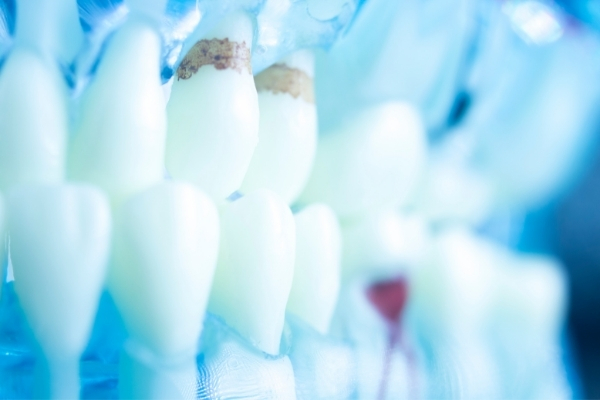 أنواع تسوس الأسنان
