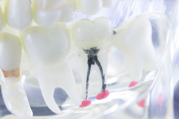 معالجة قناة جذر الأسنان