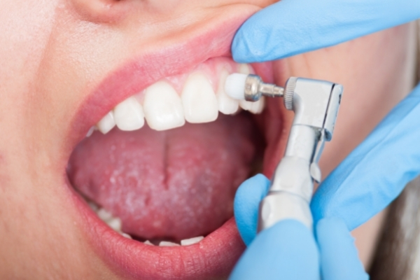 علاج البقع البيضاء في الأسنان