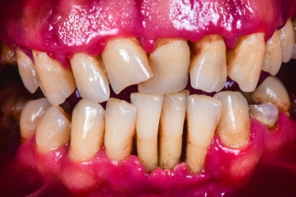 أسباب تفرق الأسنان