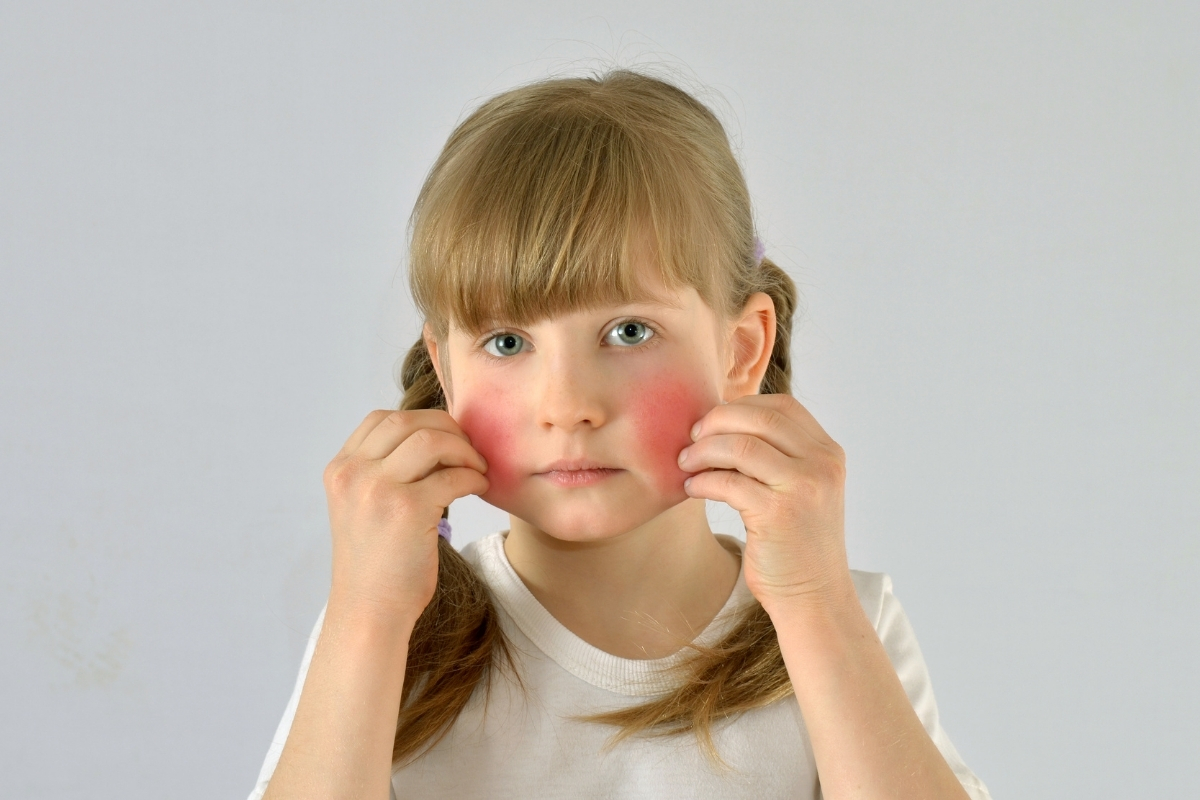 أسباب أحمرار الجلد عند الأطفال