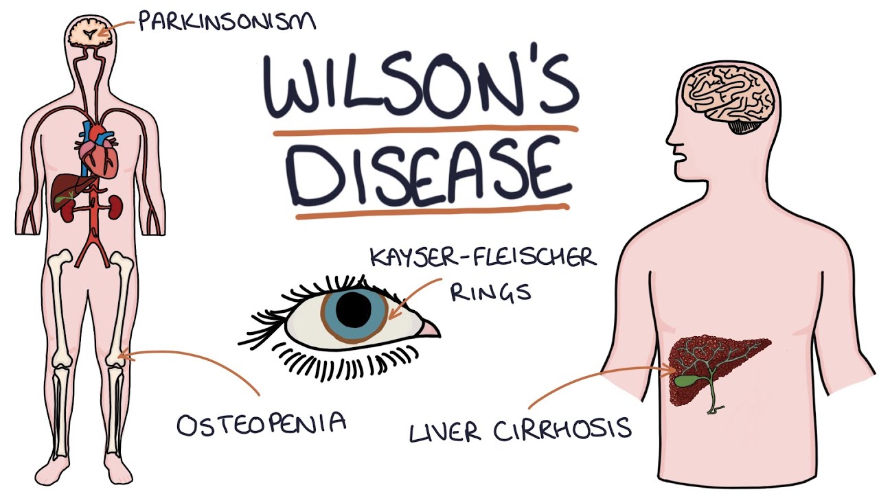 تشخيص مرض ويلسون