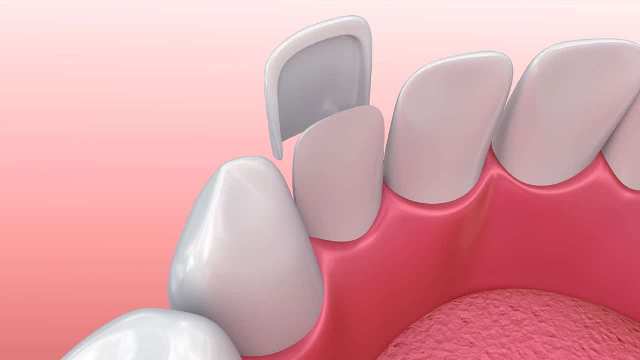Porcelain veneers for teeth