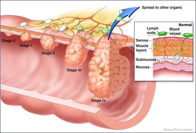 مراحل سرطان القولون والمستقيم