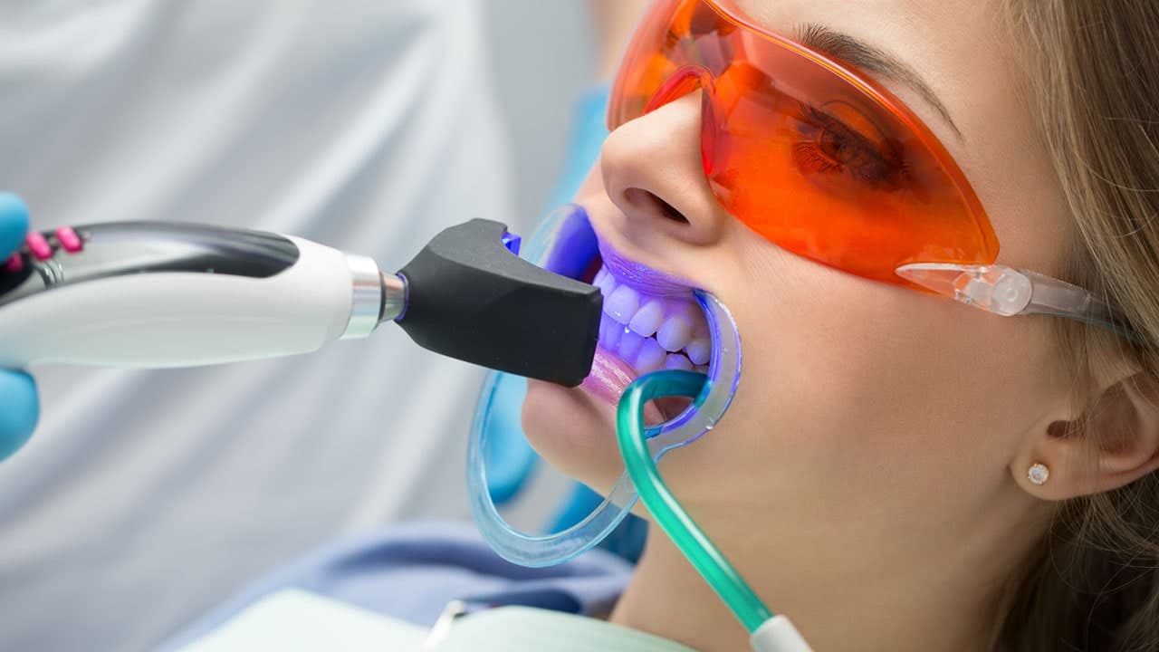 تبييض الأسنان: الآثار والفوائد والمخاطر