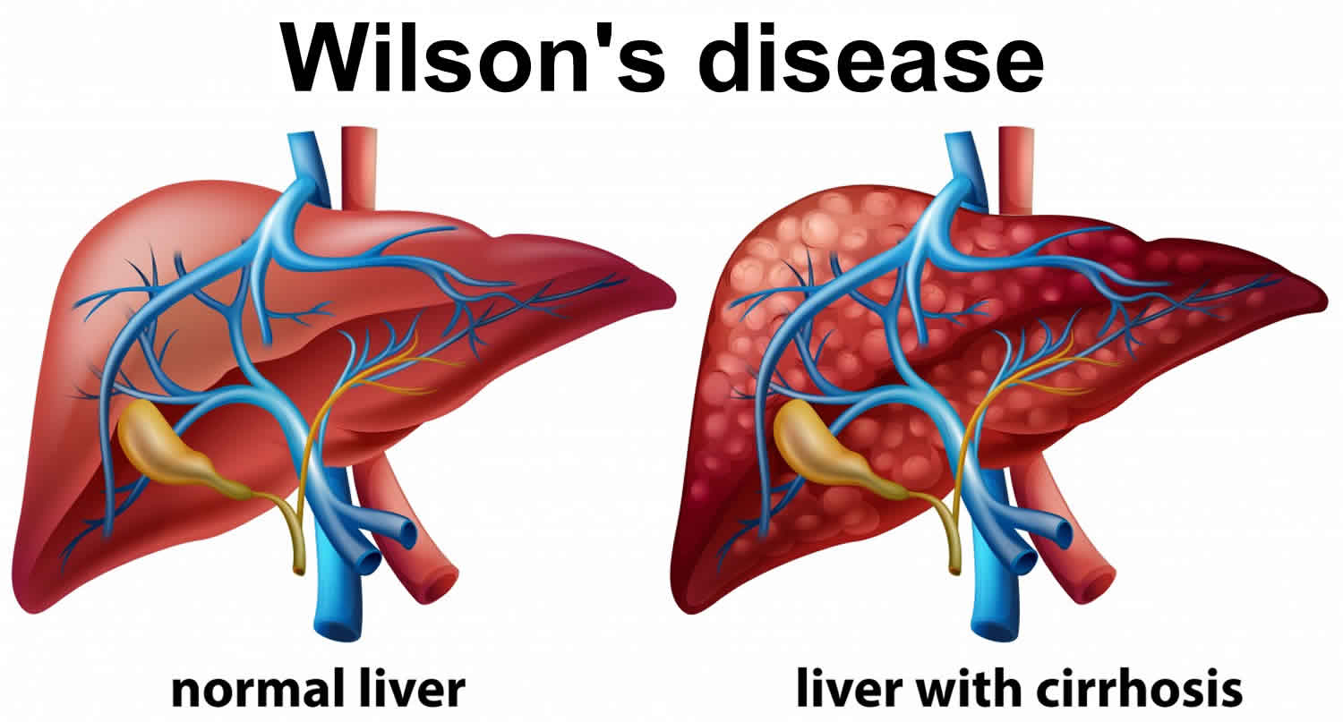 أسباب مرض ويلسون